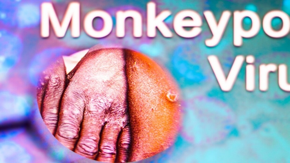WHO holds emergency meeting over 'monkeypox'