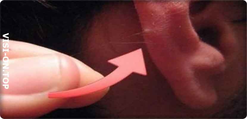 تجعُّد الأذن – وهو ما يُعرف في الوقت الحالي باسم “علامة فرانك” 