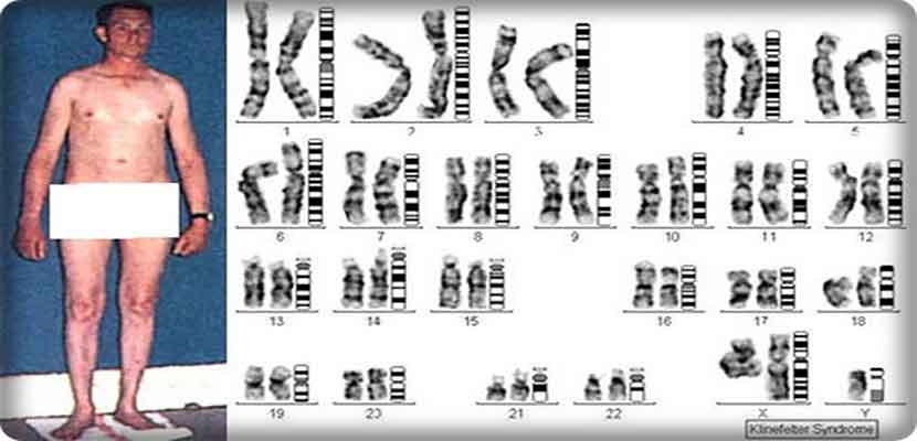 متلازمة كلاينفلتر