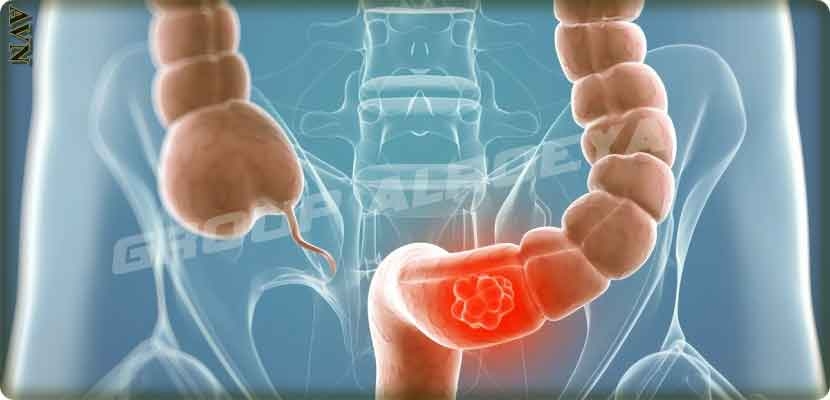 بعض النباتات تقلل خطر الإصابة بسرطان الأمعاء